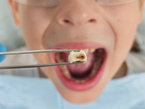Best Emergency Wisdom Teeth Removal in Meriden, CT