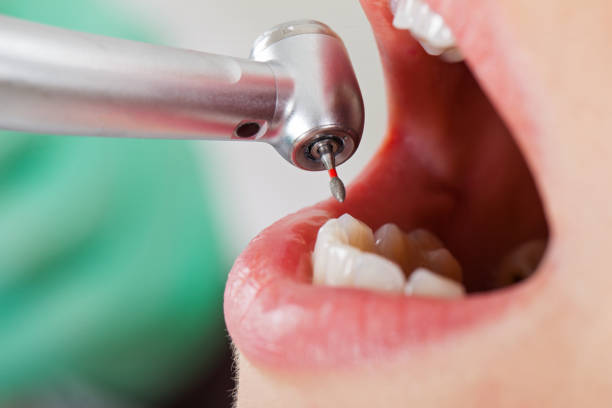Best Emergency Root Canal Treatment in Meriden, CT